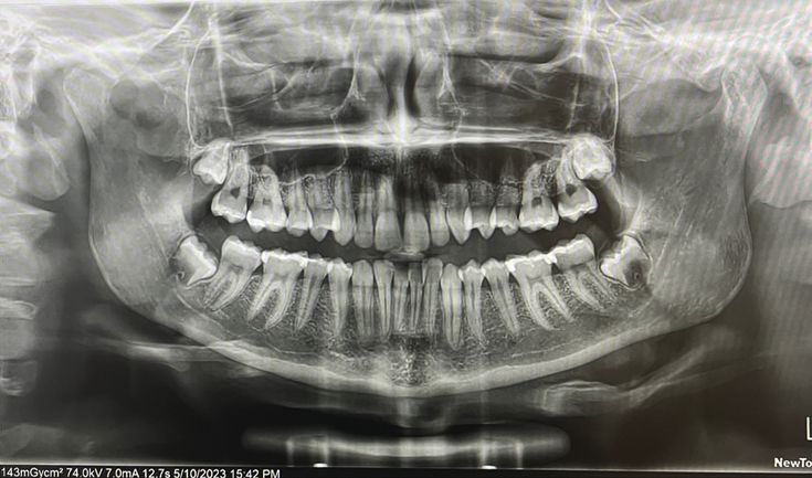 Root canal x-ray